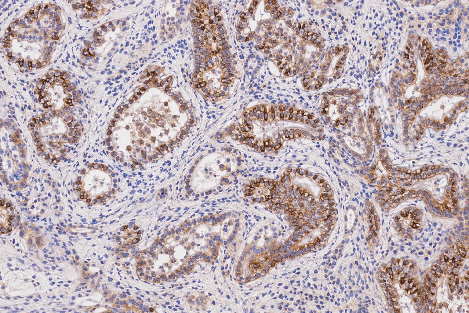 Imagen ilustrativa de tejido con tinción inmunohistoquímica marrón y contratinción azul